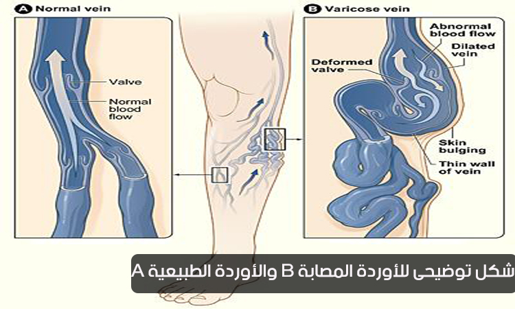 الدوالي Varicose veins