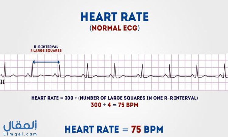 قراءة تخطيط القلب وتفسير بعض نتائجه المتوقعة في الحالة الطبيعية والمرضية